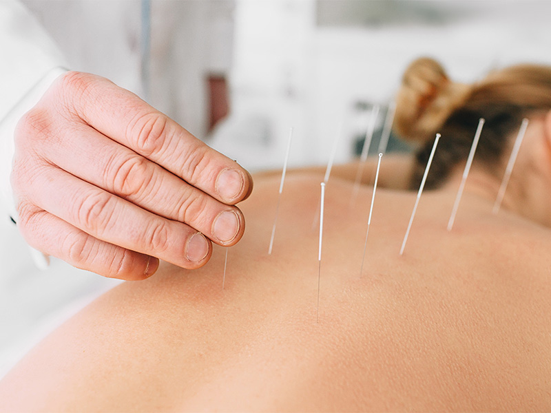 Akupunkteur setzt feine Nadeln in den Rücken einer Patientin zur Behandlung von Schmerzen und zur Förderung des Energieflusses